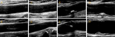 A deep learning algorithm to identify carotid plaques and assess their stability